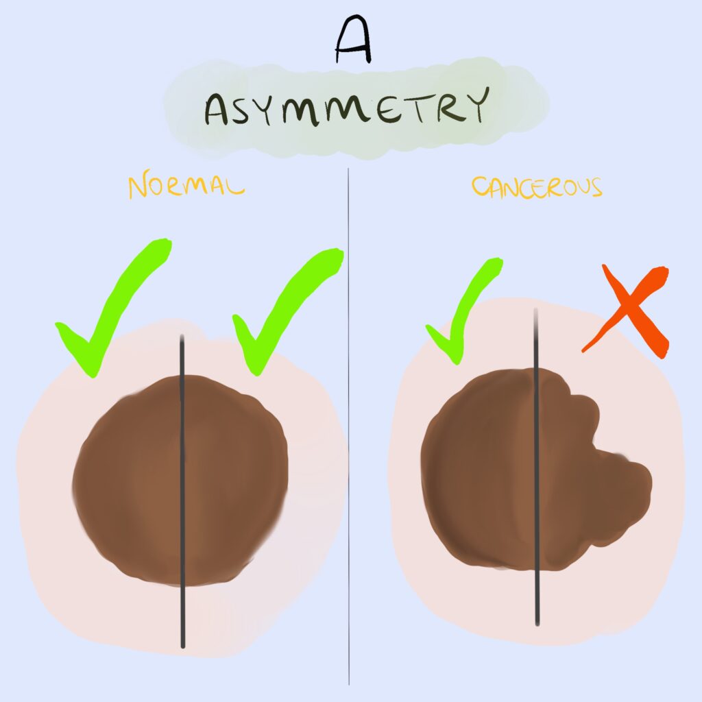 Melanoma screening tool - A for asymmetry