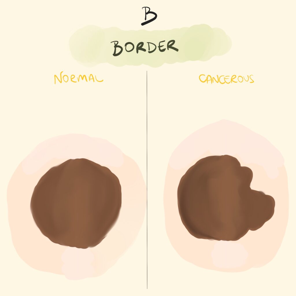 Melanoma screening B - Border