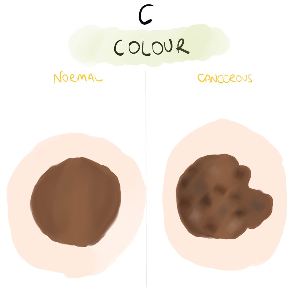 Melanoma ABCDE screening tool - C - Colour