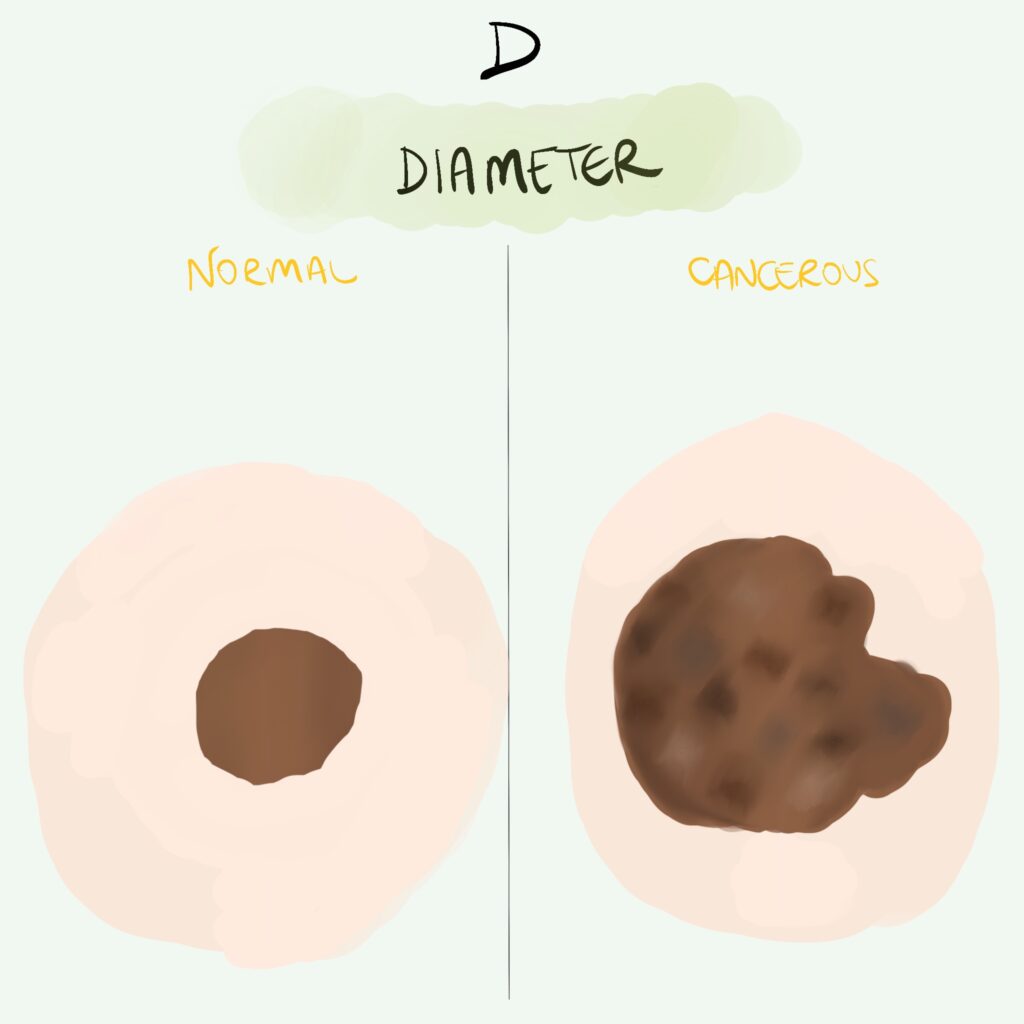 Melanoma ABCDE screening tool - D diameter