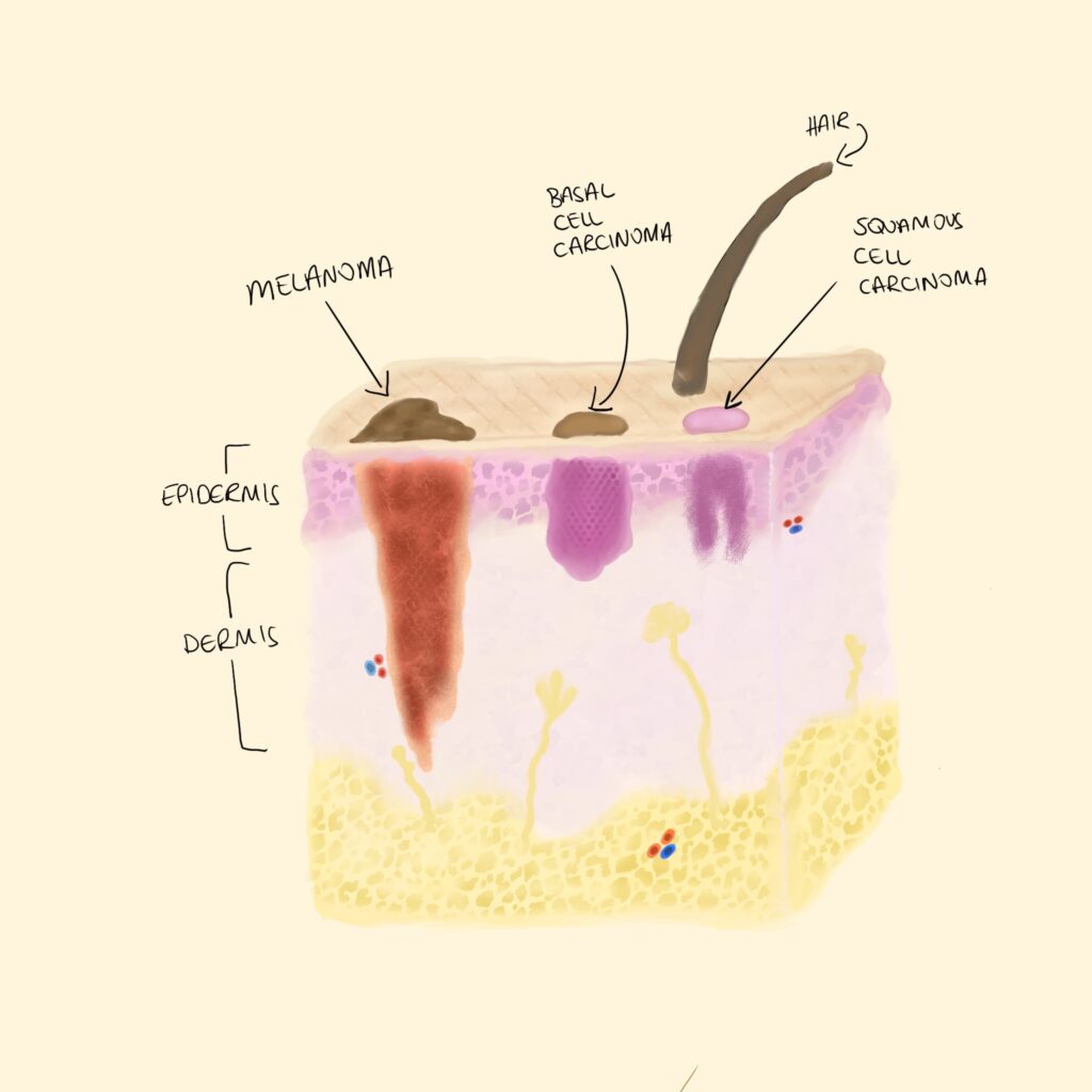 Layers of skin showing different kinds of skin cancer