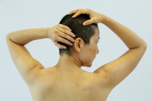 woman's back with hyperpigmentation