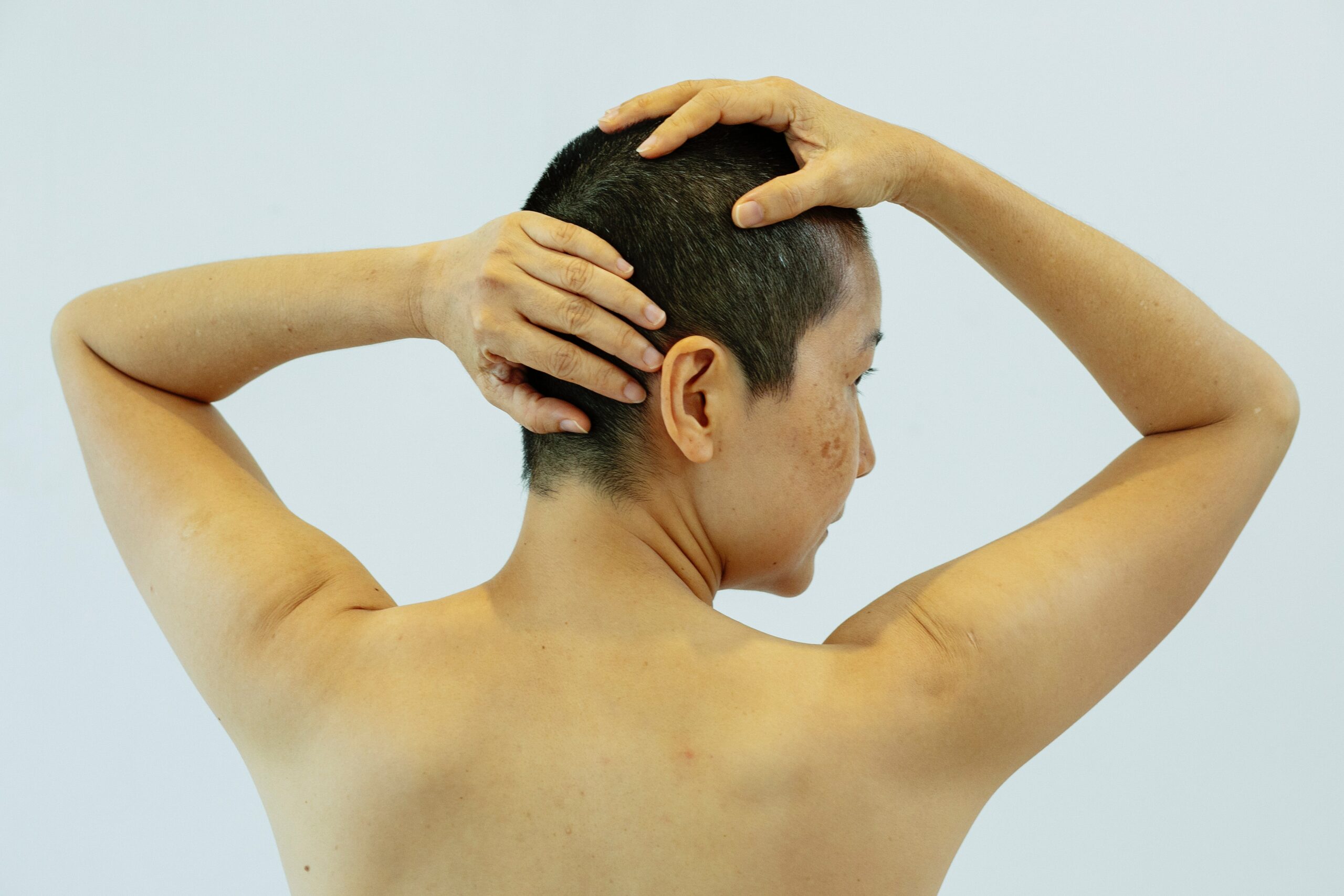 woman's back with hyperpigmentation